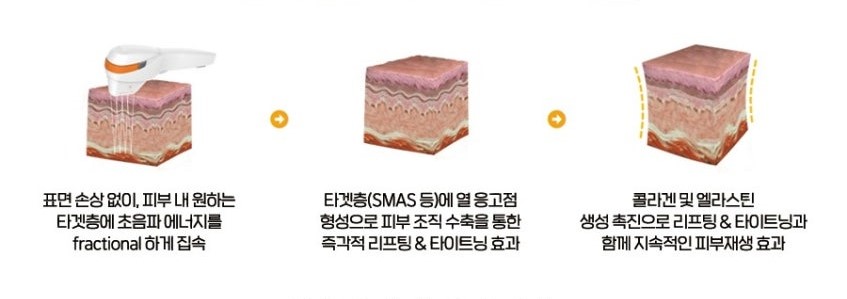 울트라스킨 타이탄