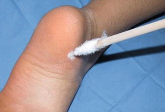 냉동치료