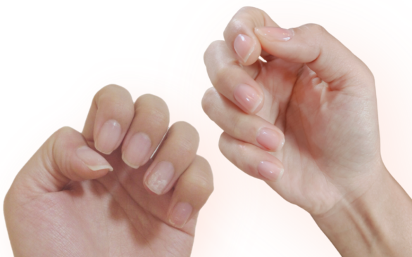 손톱 갈라짐, 원인 및 해결책, 예방법 알기