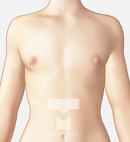 처진 가슴 개선