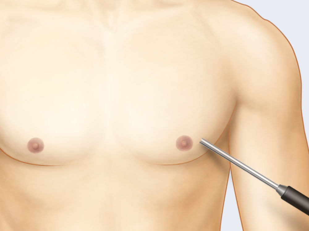 맞춤형 지방조직 제거